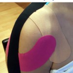 Vendaje neuromuscular en hombro doloroso